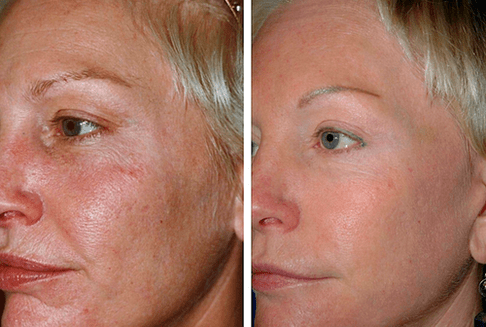 πριν και μετά την κλασματική ανανέωση του δέρματος φωτογραφία 1