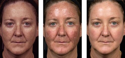πριν και μετά την κλασματική ανανέωση του δέρματος φωτογραφία 2