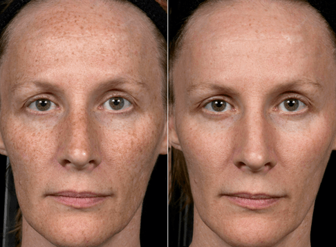 πριν και μετά την κλασματική ανανέωση του δέρματος φωτογραφία 3