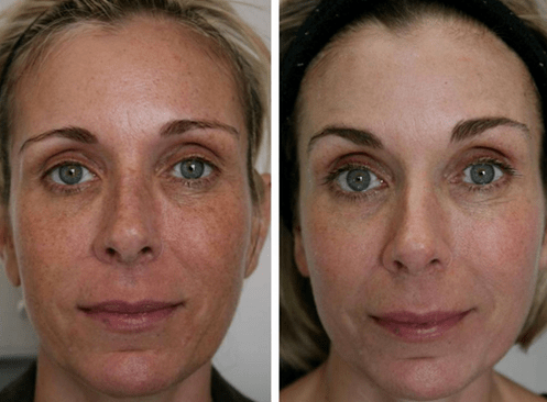 πριν και μετά την κλασματική ανανέωση του δέρματος φωτογραφία 4