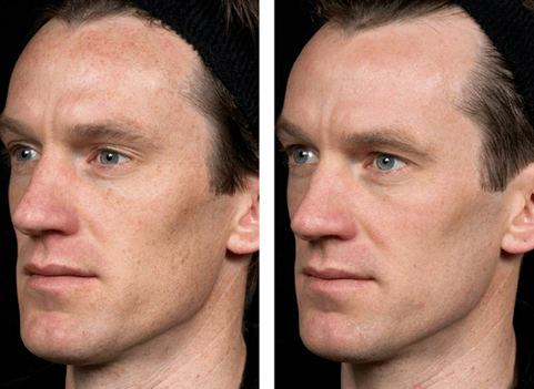 πριν και μετά την κλασματική ανανέωση του δέρματος φωτογραφία 5