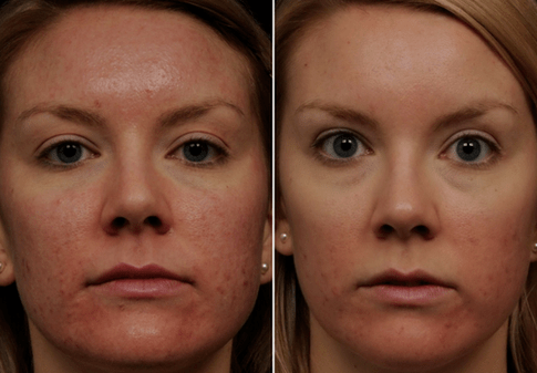 πριν και μετά την κλασματική ανανέωση του δέρματος φωτογραφία 6