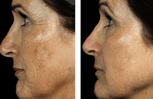 πριν και μετά την κλασματική ανανέωση του δέρματος φωτογραφία 7