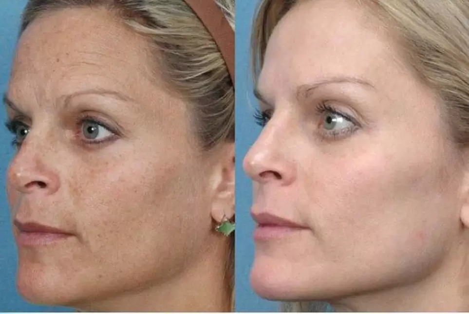 πριν και μετά την αναζωογόνηση του δέρματος, φωτογραφία 1