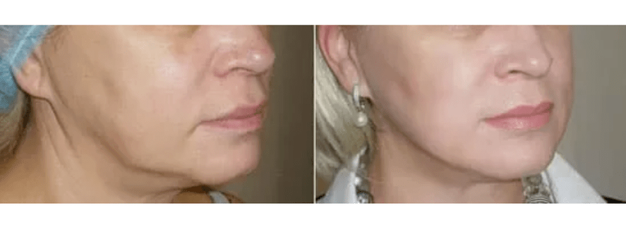 αποκατάσταση μετά την αναζωογόνηση του δέρματος