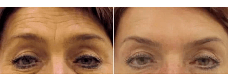 συσκευές για κλασματική αναζωογόνηση